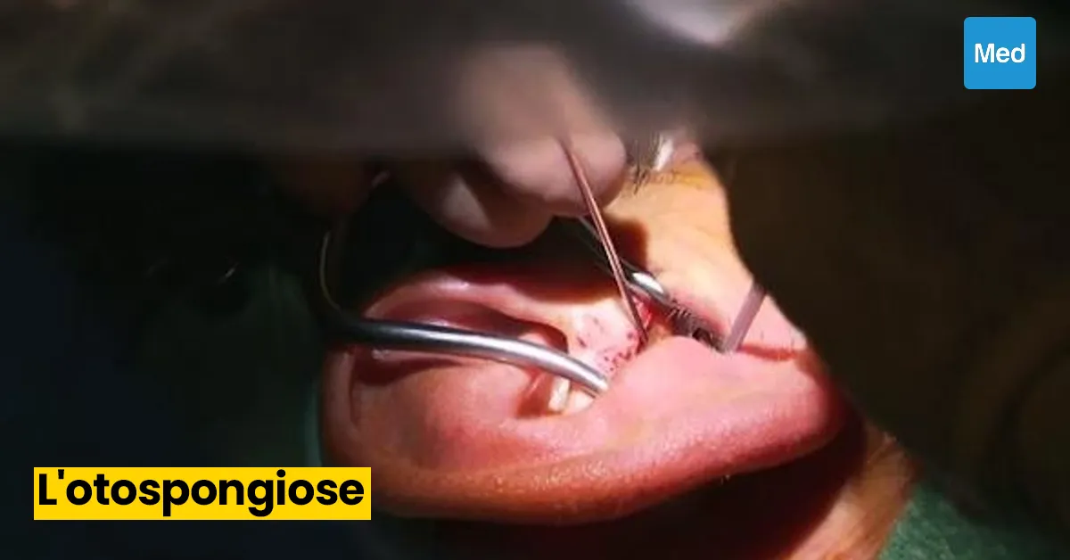 Otospongiose : tout ce que vous devez savoir